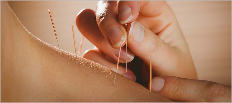 The Doctor Of Traditional Chinese Medicine Acupuncture Stock Photo, Picture  and Royalty Free Image. Image 146874284.