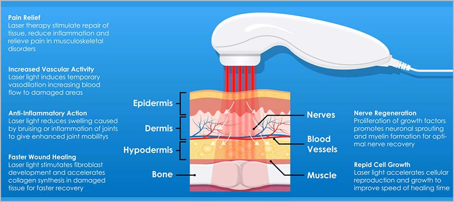 Class iv cold store laser therapy