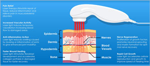 Class IV Laser Therapy Near Me in Montvale NJ