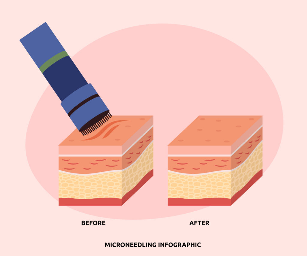 effect of microneedling graphic