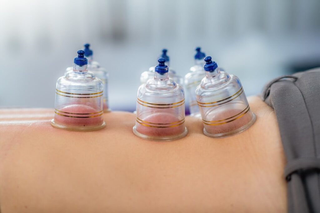 Close-up of cups placed on a patient’s back during cupping therapy to improve circulation and relieve muscle tension.