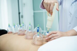 A practitioner uses a suction device to apply multiple cups on a patient’s back as part of a therapeutic treatment.