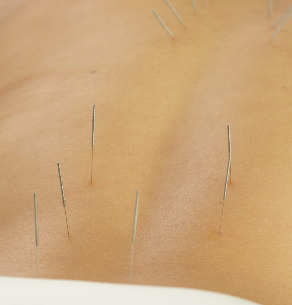 Patient getting acupuncture in their back.